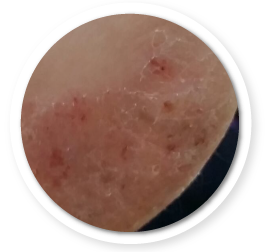 濕疹照片, eczema photo